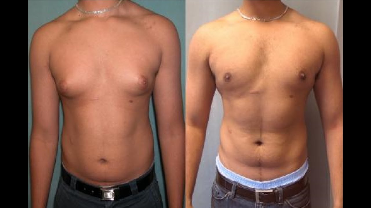 How To Get Rid Of Puffy Nipples On Men 60