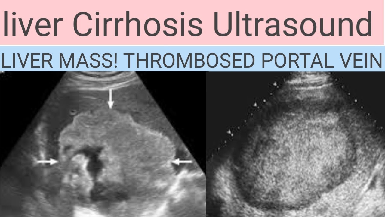Liver cirrhosis ultrasound report!How to scan liver Mass ultrasound ...