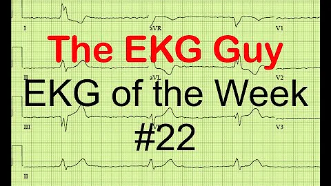 EKG/ECG of the Week #22 | The EKG Guy - www.ekg.md