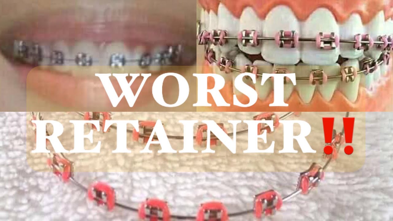 RETAINER LIKE BRACES Maristela Iranzo YouTube