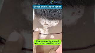 Melanocyl Lotion for Vitiligo Reviews | Side Effects  shorts