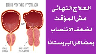 وداعاً تضخم البروستاتا وضعف الانتصاب مع ماده تادلافيل 5مجم