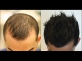 Prp Treatment For Hair Loss Reviews