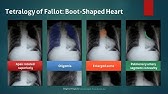 Transposition Of The Great Arteries Chest X Ray Findings Egg On