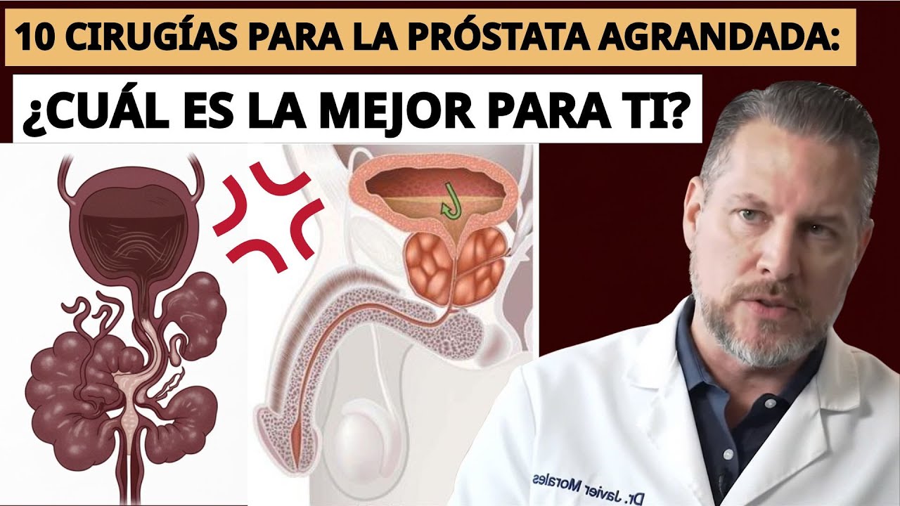 Próstata Agrandada (BPH): Un Urólogo Analiza Las 10 Cirugías Más Recomendadas | Salud Para Mayores