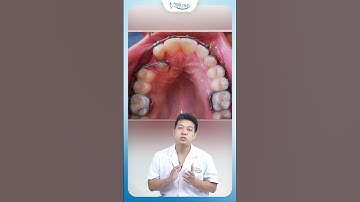 Vì Sao Răng Nanh Hay Bị Mọc Ngầm | Nha Khoa Minh Châu