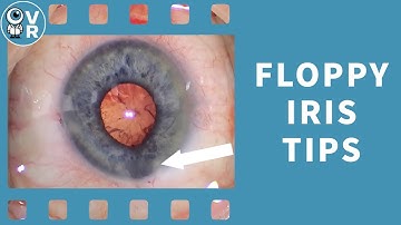 Small pupil and floppy iris case with tips and tricks