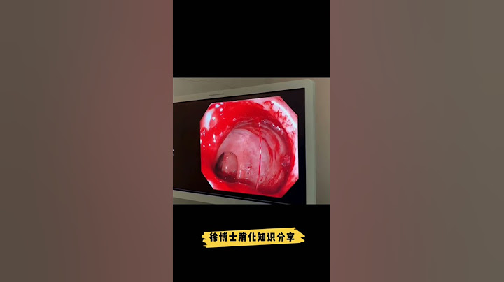 肠道出血#肠息肉#肠癌##便血#消化道出血#溃疡#shorts - 天天要闻