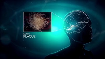 Medical Illustration of Mechanisms and secrets of Alzheimer