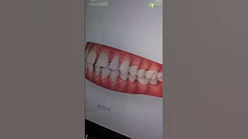Simulating dental corrections with #invisalign #iteroscanner