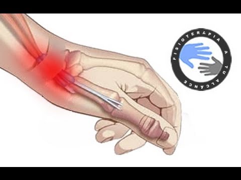 Tendinitis de quervain tratamiento kinesico
