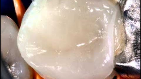 Bioclear - Replacing old almalgam