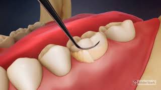 Video Tutorial: Dental Scaling