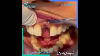 Implant Crown ඉදිරිපස අහිමි වූ දතක් සදහා Implant Crown එකක් සවි කරන හැටි දැක තිබේද 