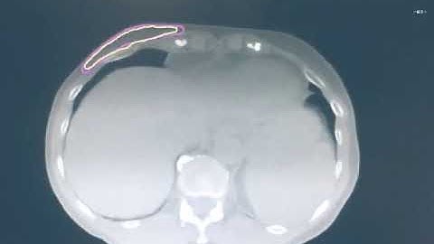 Atlas automatic segmentation (In Yellow)  vs Manual segmentation by clinical experts