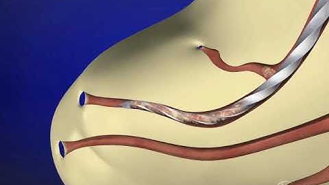 Glide Path Management - Working Length & Patency