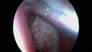Nose Foreign Body ENT Surgery @ Gouda Ramesh ENT Centre Hanamkonda