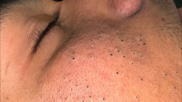 The Ultimate Facial Care Routine For Acne — Blackhead Removal Secrets