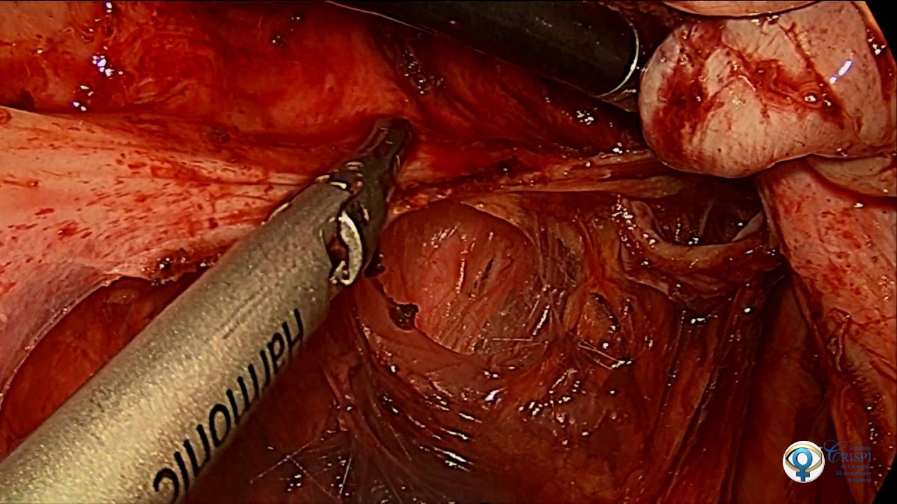 Ooforoplastia direita e liberação de aderências por vídeo/ Oophoroplasty  and video adhesion release 