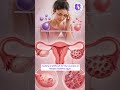 Trying to conceive but not getting results? It could be Polycystic Ovarian Disease #pcod #pcos