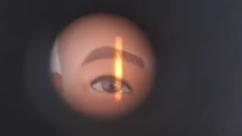 Retinoscopy: Types of Red Reflex, Real Footages On Model Eye!