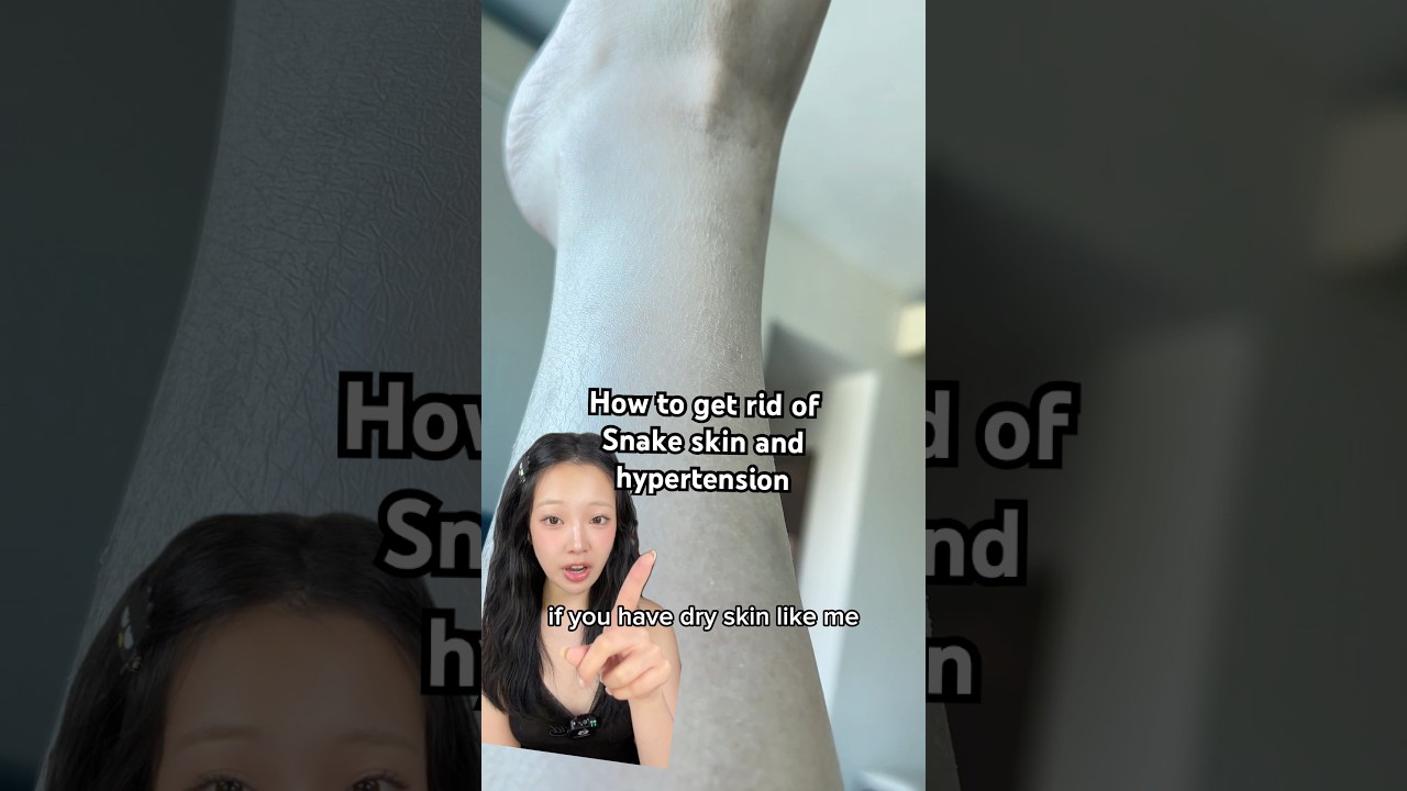 how to get rid of snake skin and hyperpigmentation on your body safely!!