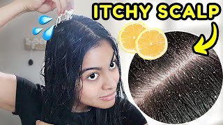 How I GET RID OF DANDRUFF in one hair wash! *lemon juice treatment*
