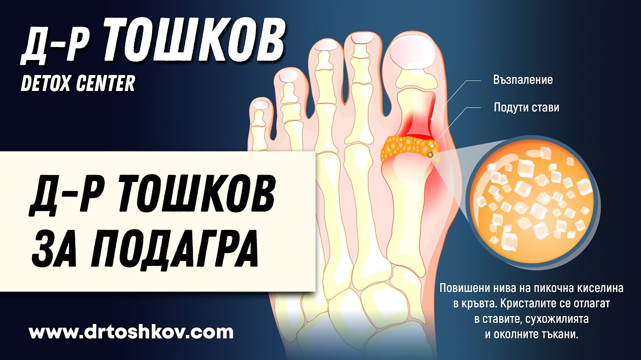 д-р Тошков за Подагра