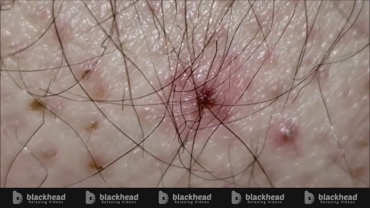 How To Treat Ingrown Hair YouTube How To Treat Ingrown Hair YouTube