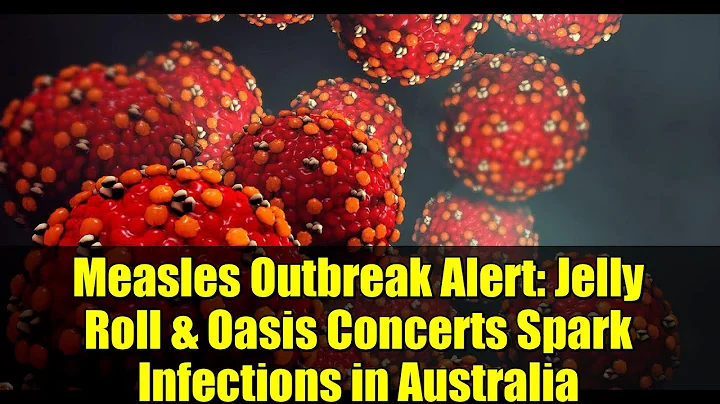 Measles Outbreak Alert: Jelly Roll & Oasis Concerts Spark Infections in Australia