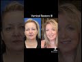 Jawdropping facelift transformation