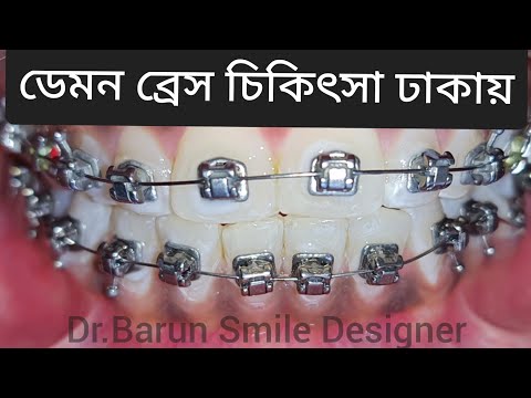 Braces Cost In Bangladesh Dhaka