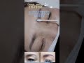 😎심각했던 이중눈썹문신,, 3d콤보시술1차 딱지탈각후 완전달라진영상,,눈썹복구전문 댄디,,상담01083152380