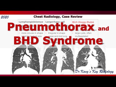 Vidéo: Un Revêtement Pleural Total De Maille De Cellulose Absorbable Empêche La Récidive Du Pneumothorax Chez Les Patients Atteints Du Syndrome De Birt-Hogg-Dubé