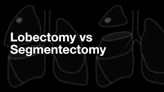 3 Minute Papers: Lobectomy vs Segmentectomy for Lung Cancer