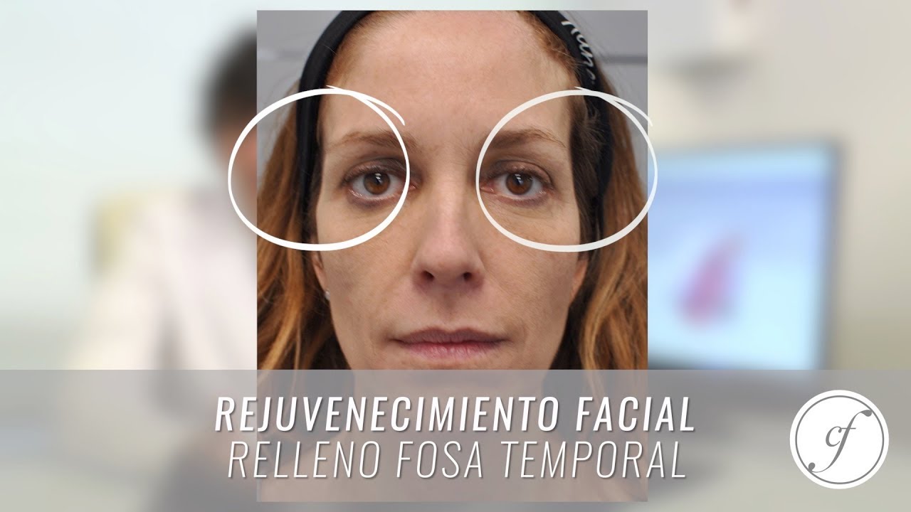 camera iphone 8 plus apk Rejuvenecimiento facial sin cirugía (fosa temporal)