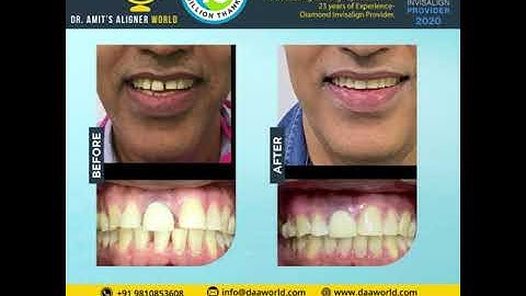 Before/after gapped teeth cases Treated by Dr Amit Sachdeva at Daaworld.