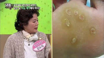 티눈과 사마귀 구별해서 제거해야 한다 [내 몸 사용 설명서] 45회 20150409