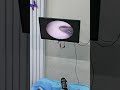 耳垢そうじ/耳が痒くなった鼓膜に付着した軟耳垢/032