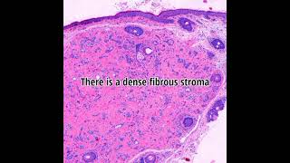 Histopathology of Syringoma #shorts #dermpath #dermatopathology