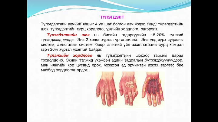 26  Түлэгдэлт ба хөлдөлтийн үеийн бие бялдрын нөхөн сэргээлт XIII долоо хоног 2021 11 22 26