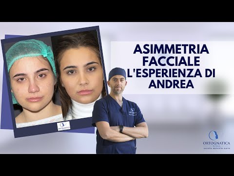 Asimmetria Facciale: l&rsquo;esperienza di Andrea con la chirurgia ortognatica