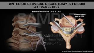 Anterior Cervical Discectomy & Fusion at C56 & C67