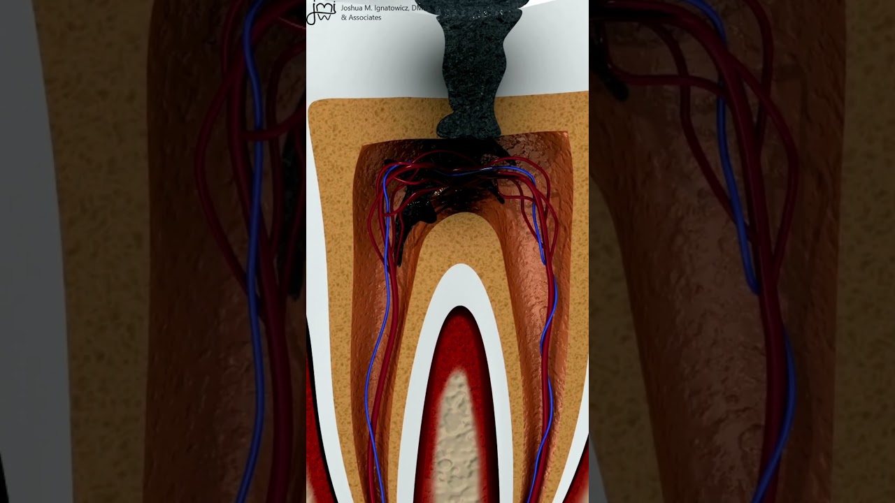 Root Canal Procedure in Henderson | 