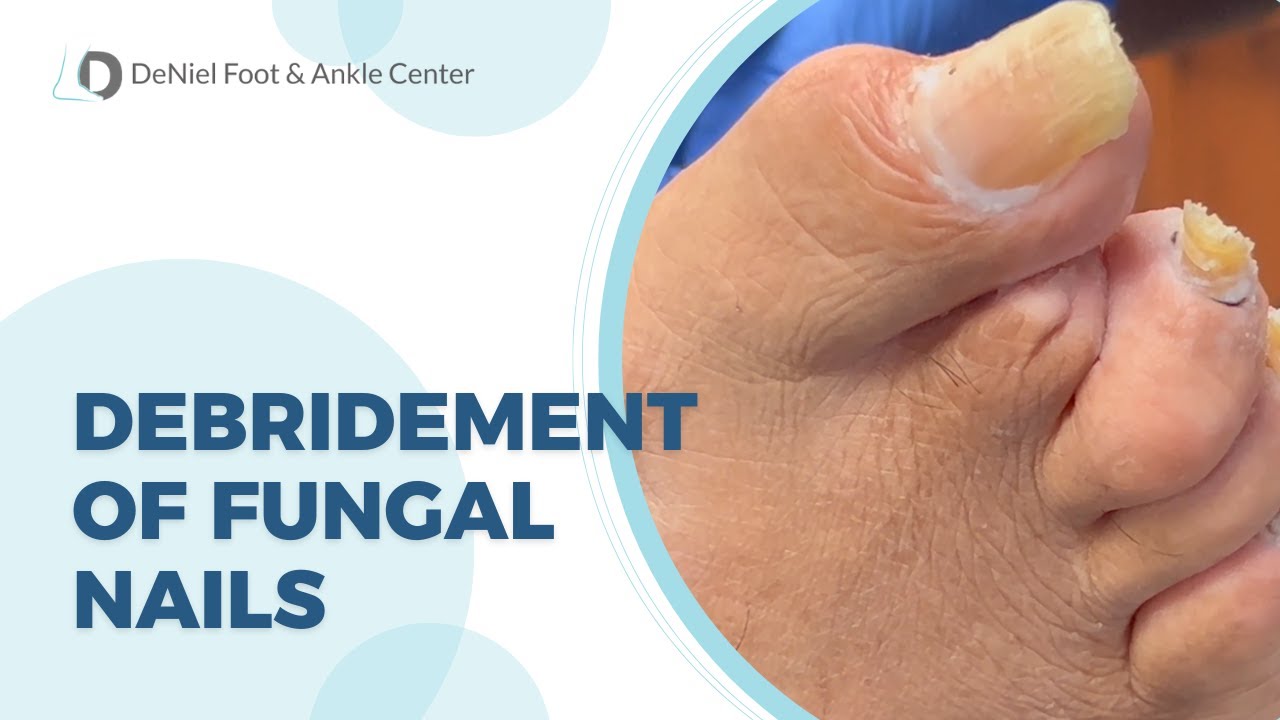 Debridement of Fungal Nails fungalnail toenailfungus 