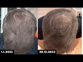 Topical finasteride 1 year update