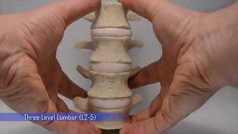 Hypermobility Lumbar Model - Dynamic Disc Designs