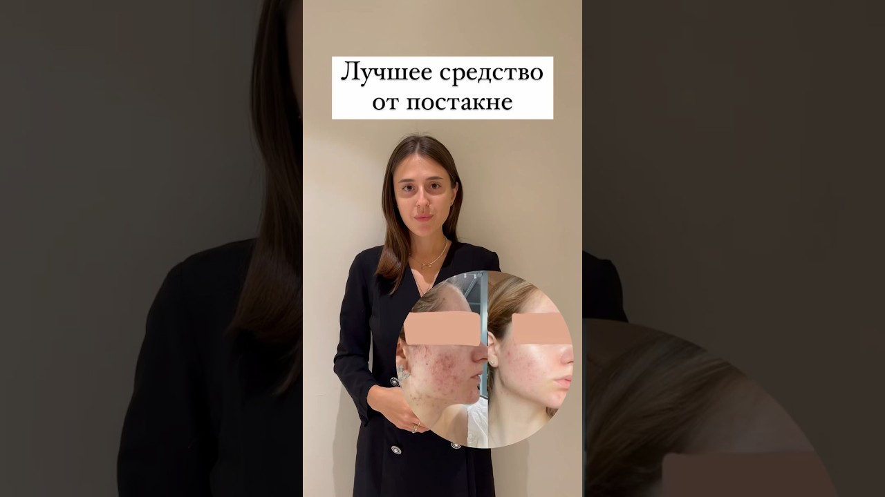 Это средство избавить вас от постакне #акне #уходзакожей #прыщи #уходзалицом