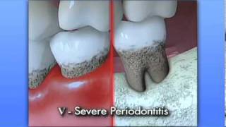 Types of Gum Disease - 5 stages.mov