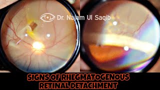 Clinical Signs Of Rhegmatogenous Retinal Detachment